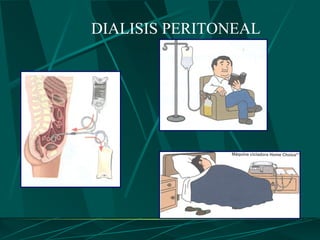 DIALISIS PERITONEAL
 