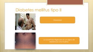 Diabetes mellitus tipo II
La acantosis Nigricans es un signo de
resistencia a la insulina
Obesidad
 