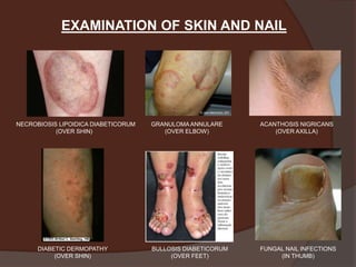 Claudication Rash Diabetes Mellitus: Presentation and CLinical Examination | PPTX