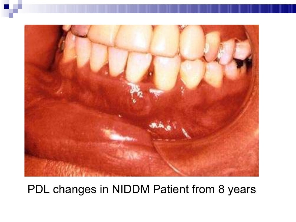 Diabetes Mellitus & Its Oral Manifestations