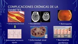 COMPLICACIONES CRÓNICAS DE LA
DIABETES.
• Arterioesclerosis • Accidentes
cerebrovasculares.
• Retinopatía
s..
• Enfermedad coronaria
aguda.
• Enfermedad renal
crónica
• Neuropatías
periféricas
 