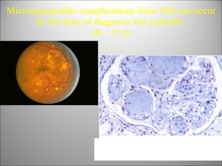 Microangiopathic complications from DM can occur by the time of diagnosis but typically  10 – 15 yr 