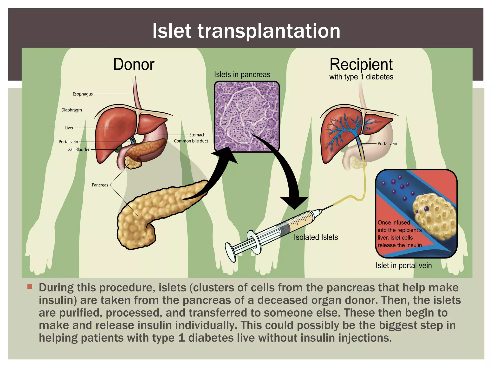 During this procedure, islets (clusters of cells from the pancreas that help make insulin) are taken from the pancreas of a deceased organ donor. Then, the islets are purified, processed, and transferred to someone else. These then begin to make and release insulin individually. This could possibly be the biggest step in helping patients with type 1 diabetes live without insulin injections.  Islet transplantation 