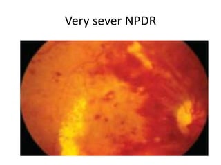 Diabetes retinopathy