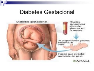 Diabetes Gestacional

 