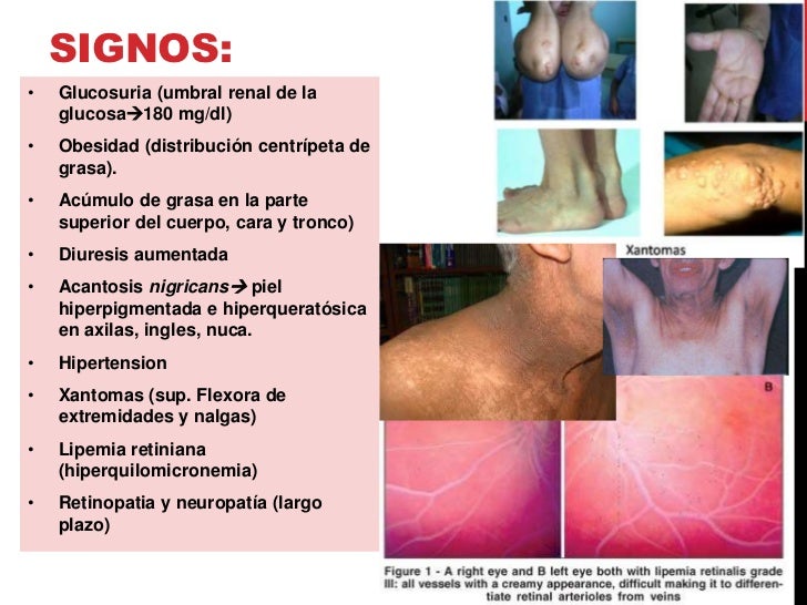 Diabetes Mellitus tipo 2