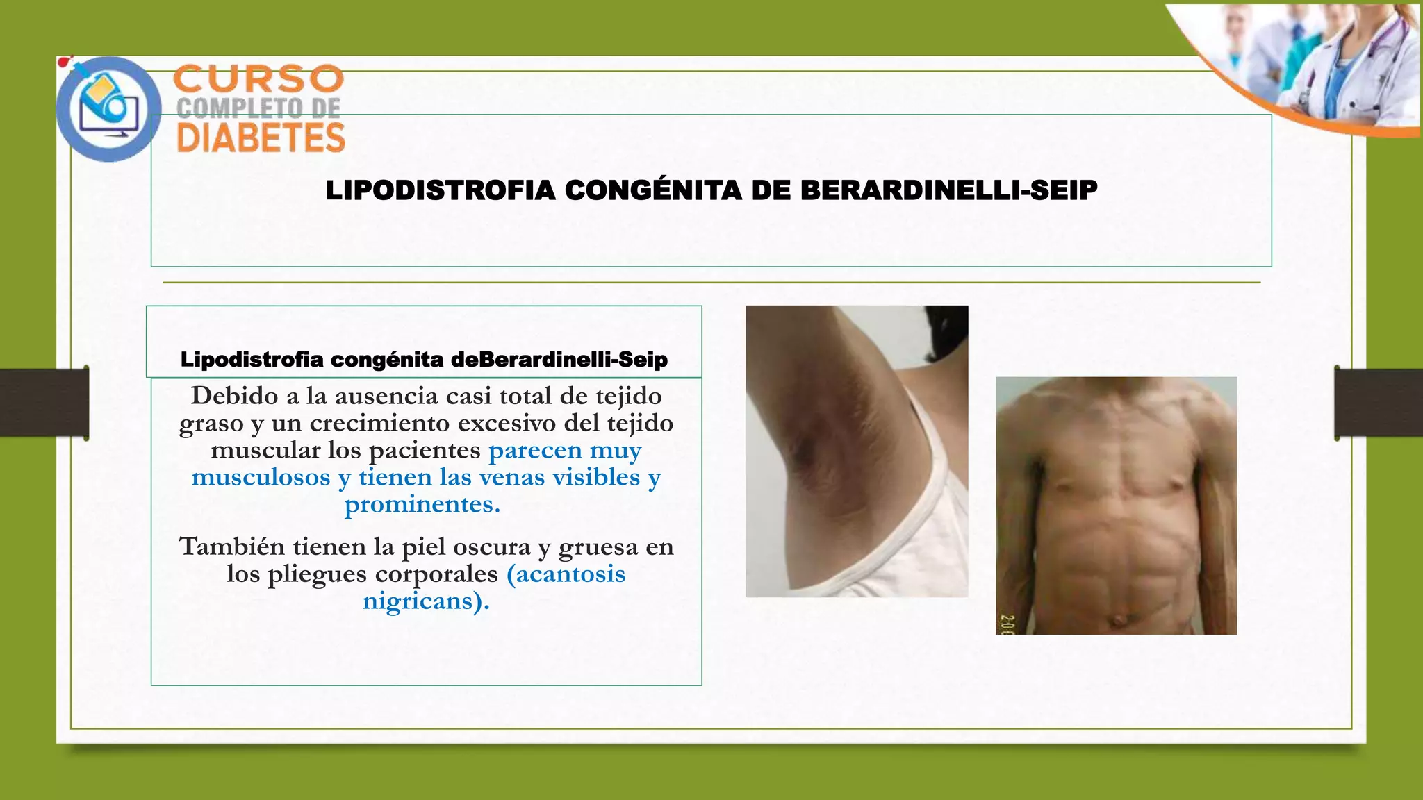 DIABETES Y CUADRO GENETICO LIPODISTROFIA CONGENITA GENERALIZADA.pptx