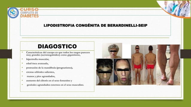 DIABETES Y CUADRO GENETICO LIPODISTROFIA CONGENITA GENERALIZADA.pptx