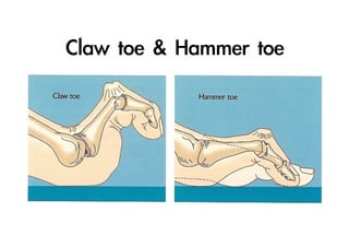 Claw	 toe	 &	 Hammer	 toe

 