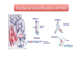 Fontaine	
  classiﬁcaZon	
  of	
  PAD

 