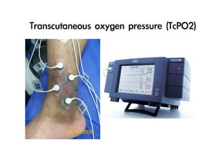 Transcutaneous	 oxygen	 pressure	 (TcPO2)

 
