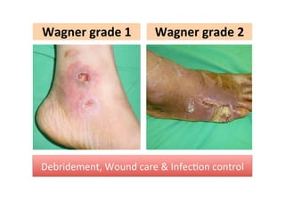 Wagner	
  grade	
  1

Wagner	
  grade	
  2

Debridement,	
  Wound	
  care	
  &	
  InfecZon	
  control

 
