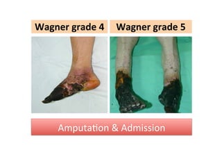 Wagner	
  grade	
  4
 Wagner	
  grade	
  5

AmputaZon	
  &	
  Admission

 