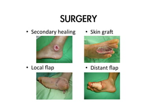 SURGERY
•  Secondary	
  healing

•  Skin	
  gra@

•  Local	
  ﬂap

•  Distant	
  ﬂap

 
