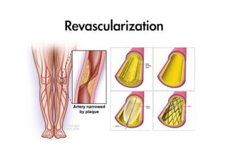 Revascularization

 