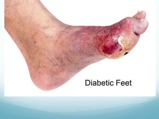 Diabetic Feet
 
