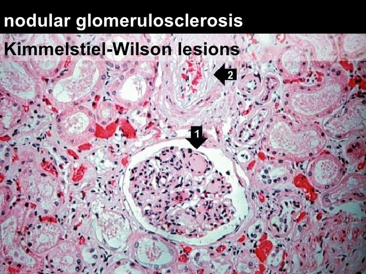 Diabetic Nephropathy
