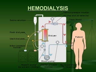 HEMODIALYSIS 