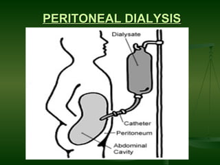 PERITONEAL DIALYSIS 