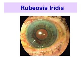 Negative Rubeosis diabetic-retinopathy.ppt nursing contino | PPT
