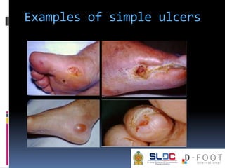 Examples of simple ulcers
 