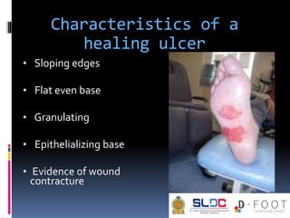 Characteristics of a
healing ulcer
• Sloping edges
• Flat even base
• Granulating
• Epithelializing base
• Evidence of wou...