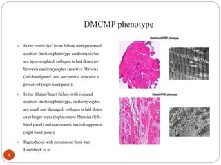 DMCMP phenotype
 In the restrictive/ heart failure with preserved
ejection fraction phenotype cardiomyocytes
are hypertrophied, collagen is laid down in-
between cardiomyocytes (reactive fibrosis)
(left-hand panel) and sarcomeric structure is
preserved (right hand panel).
 In the dilated/ heart failure with reduced
ejection fraction phenotype, cardiomyocytes
are small and damaged, collagen is laid down
over larger areas (replacement fibrosis) (left-
hand panel) and sarcomeres have disappeared
(right hand panel)
 Reproduced with permission from Van
Heerebeek et al.
4
 