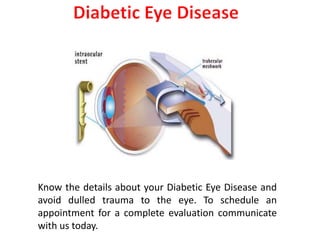 Know the details about your Diabetic Eye Disease and
avoid dulled trauma to the eye. To schedule an
appointment for a complete evaluation communicate
with us today.
 