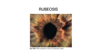Negative Rubeosis Diabetic Eye Disease: clinical approach and management.pdf