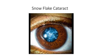 Snowflake Disorder Diabetic Eye Disease etiology, management, classification | PPTX