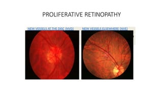 Nvd Optometry Diabetic Eye Disease etiology, management, classification | PPTX