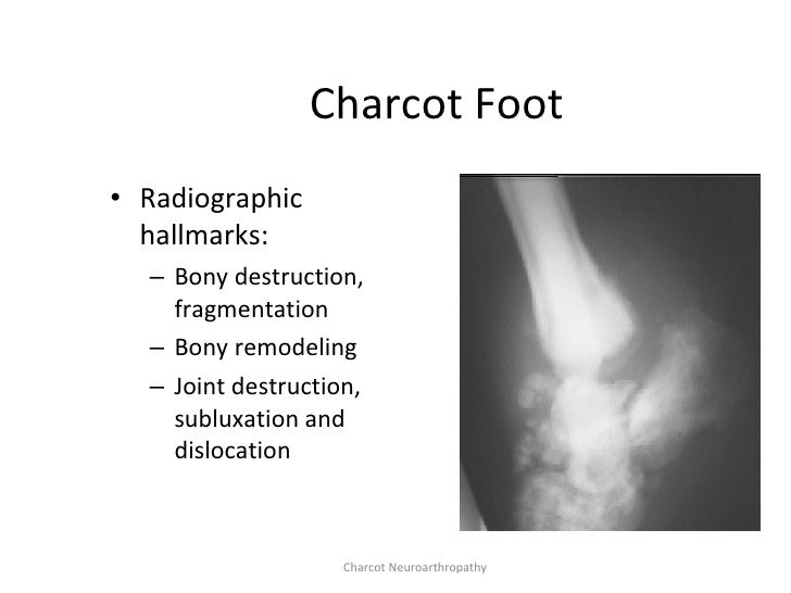 Diabetic Foot