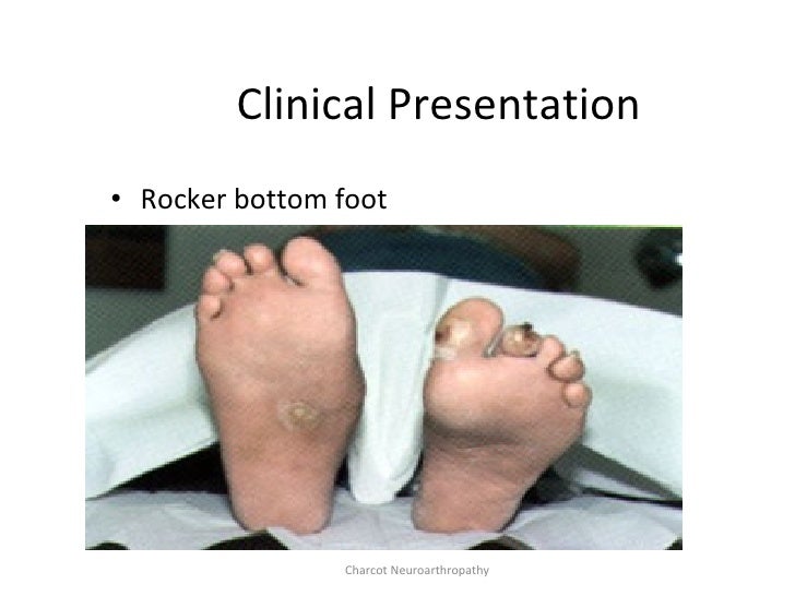 Diabetic Foot
