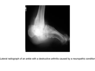 Lateral radiograph of an ankle with a destructive arthritis caused by a neuropathic condition
 