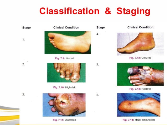 Diabetic foot Diabetic foot