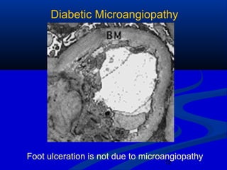 12
Diabetic Microangiopathy
Foot ulceration is not due to microangiopathy
 