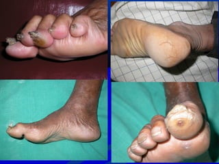 6
Pes Cavus
Ulceration at the tip
 