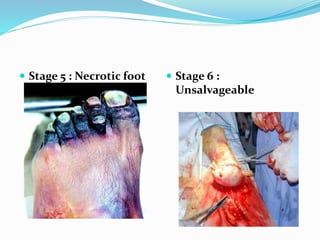  Stage 5 : Necrotic foot  Stage 6 :
Unsalvageable
 