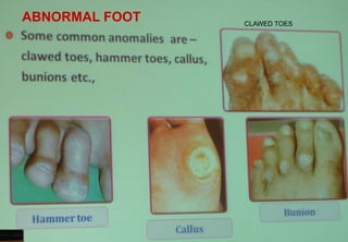 ABNORMAL FOOT CLAWED TOES
 