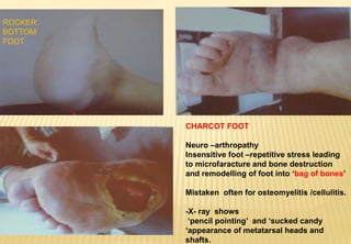 CHARCOT FOOT
Neuro –arthropathy
Insensitive foot –repetitive stress leading
to microfaracture and bone destruction
and remodelling of foot into ‘bag of bones’
Mistaken often for osteomyelitis /cellulitis.
-X- ray shows
‘pencil pointing’ and ‘sucked candy
‘appearance of metatarsal heads and
shafts.
ROCKER
BOTTOM
FOOT
 