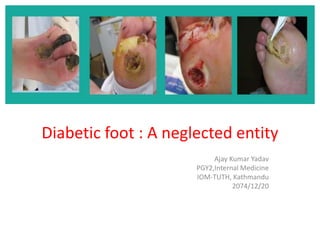 Diabetic foot : A neglected entity
Ajay Kumar Yadav
PGY2,Internal Medicine
IOM-TUTH, Kathmandu
2074/12/20
 
