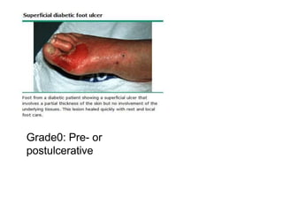 Grade0: Pre- or
postulcerative
 