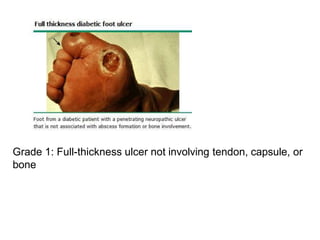 Grade 1: Full-thickness ulcer not involving tendon, capsule, or
bone
 