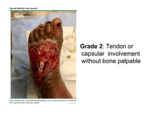 Grade 2: Tendon or
capsular involvement
without bone palpable
 