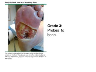 Grade 3:
Probes to
bone
 