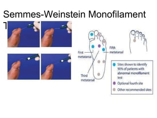 Semmes-Weinstein Monofilament
Test
 