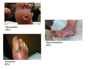 Neuropathic
DFU
Neuroischaemic
DFU
Ischaemic
DFU
 