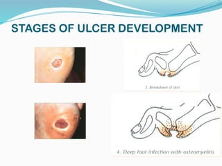 STAGES OF ULCER DEVELOPMENT
 