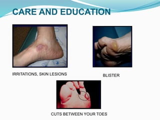 CARE AND EDUCATION
IRRITATIONS, SKIN LESIONS BLISTER
CUTS BETWEEN YOUR TOES
 
