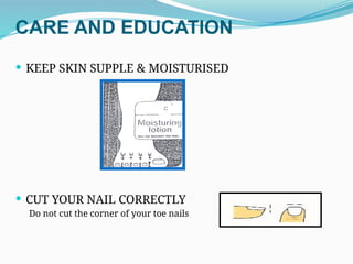 CARE AND EDUCATION
 KEEP SKIN SUPPLE & MOISTURISED
 CUT YOUR NAIL CORRECTLY
Do not cut the corner of your toe nails
 